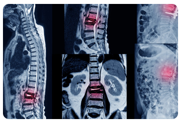 Cirugía de columna vertebral
