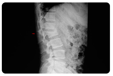 Fracturas en columna por osteoporosis